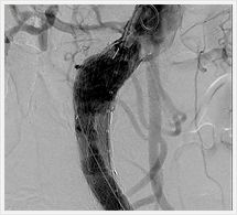 ステントグラフト挿入術直後の造影
（上部）
