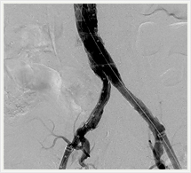 ステントグラフト挿入術直後の造影
（下部）