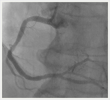 右冠状動脈治療後