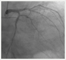 左冠状動脈治療前