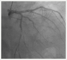 左冠状動脈治療後