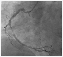 右冠状動脈治療前
